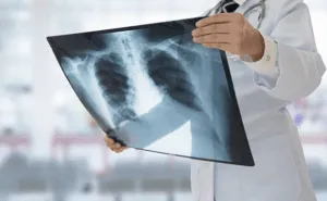 Medico osserva radiografia del torace